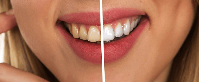 Is laser whitening safe for your teeth Mt Druitt NSW Dentist