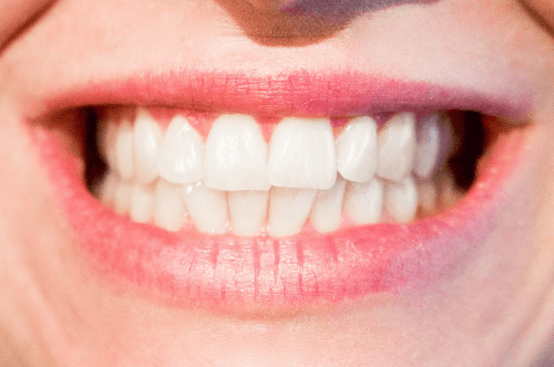 Dentist performing Laser teeth whitening mt druitt NSW