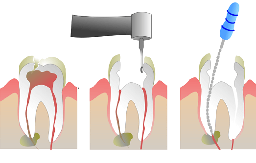 Root Canal Treatment Mt Druitt Dentist