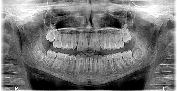 Wisdom Teeth Removal Mt Druitt NSW